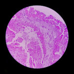 histology-metastatic-papillary-adenocarcinoma